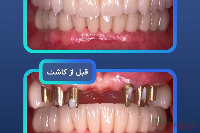 ایمپلنت دندان در مشهد  با اقساط بلندمدت و شرایط ویژه